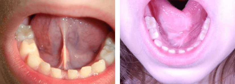 frenectomy before and after