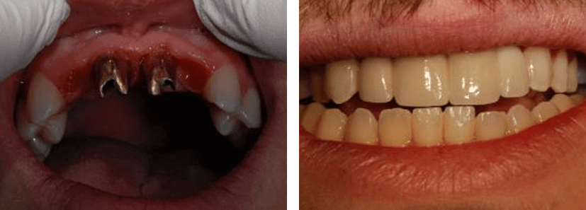 front dental implants before and after