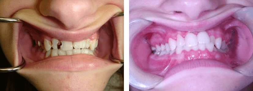 tooth colored fillings before and after